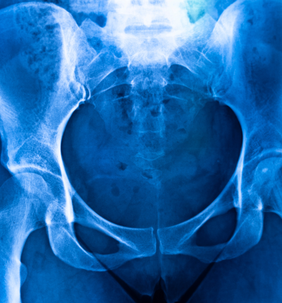 fistulogram