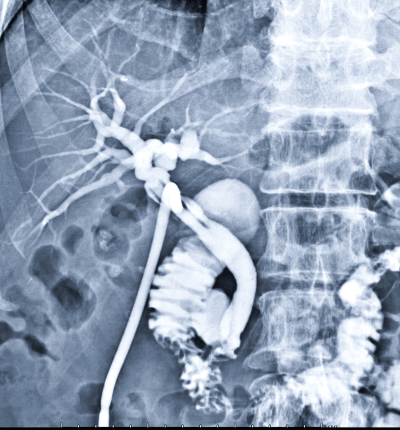 t-tube-cholangiogram